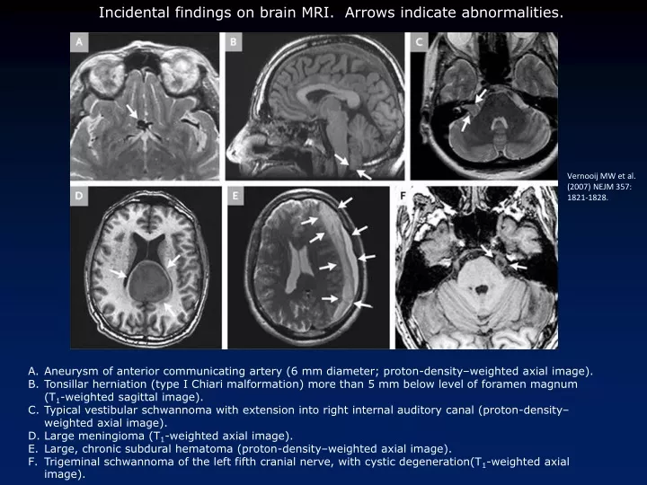 incidental findings on brain mri arrows indicate