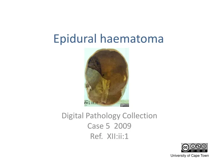 epidural haematoma