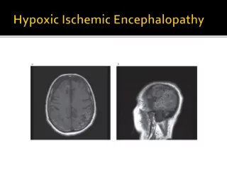 Hypoxic Ischemic Encephalopathy