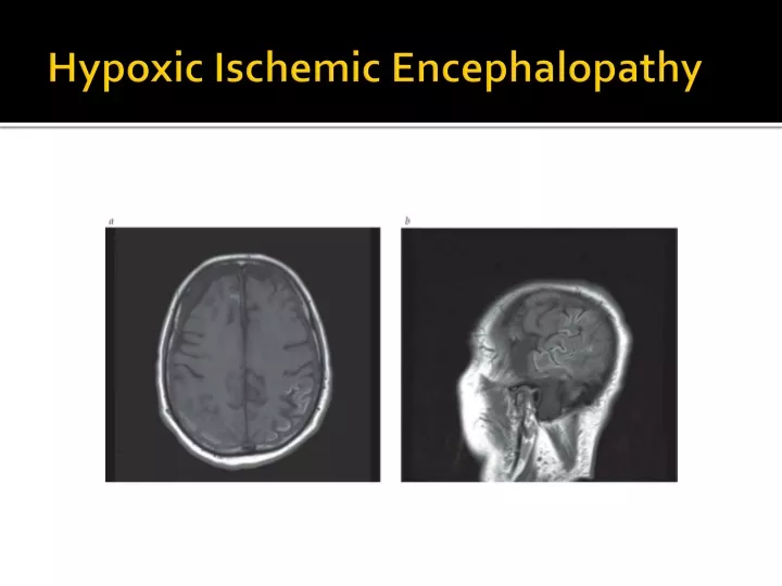 hypoxic ischemic encephalopathy
