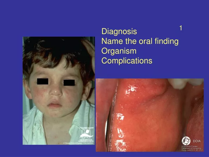 diagnosis name the oral finding organism complications