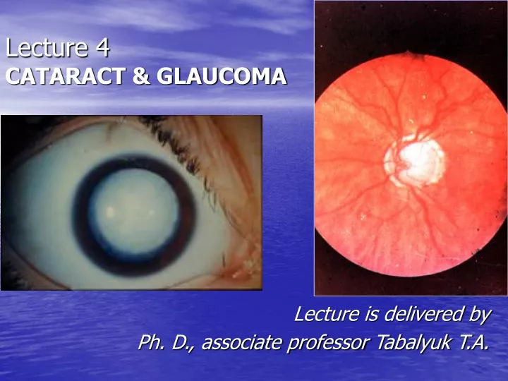 lecture 4 cataract glaucoma