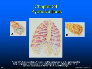Chapter 24  Kyphoscoliosis