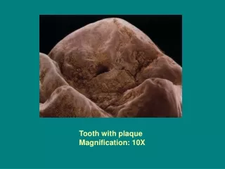 Tooth with plaque Magnification: 10X