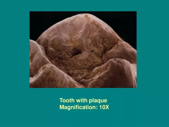 tooth with plaque magnification 10x
