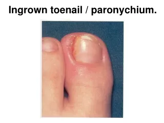 Ingrown toenail / paronychium.