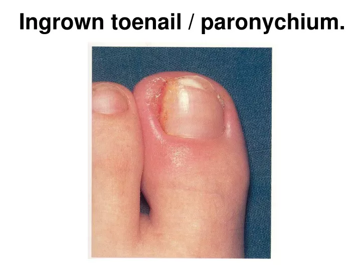 ingrown toenail paronychium