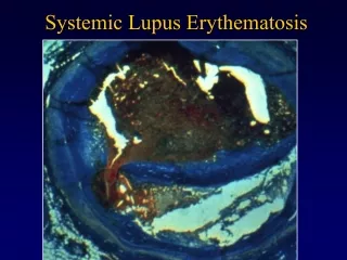 Systemic Lupus Erythematosis