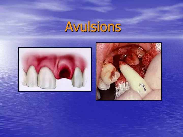 avulsions