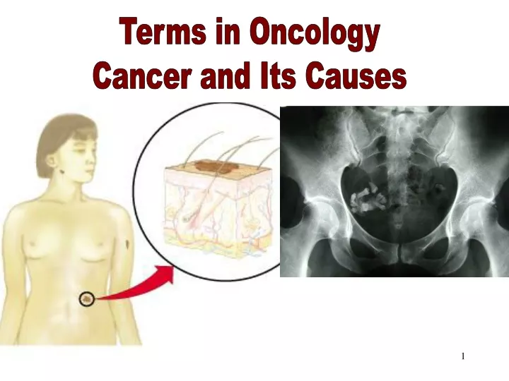terms in oncology its causes
