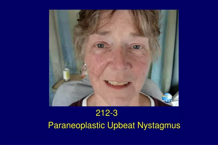212 3 paraneoplastic upbeat nystagmus