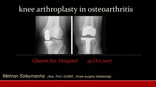 knee arthroplasty in osteoarthritis