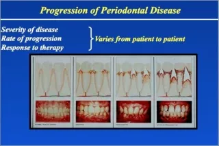 Risk Factors for Periodontal Disease