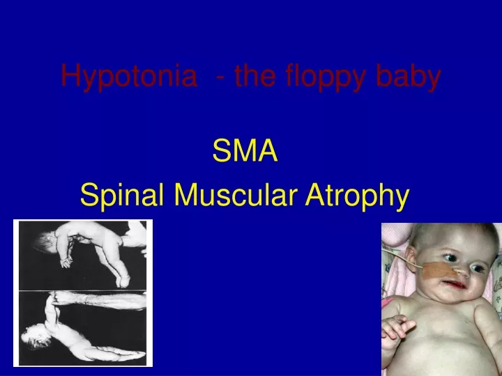 hypotonia the floppy baby