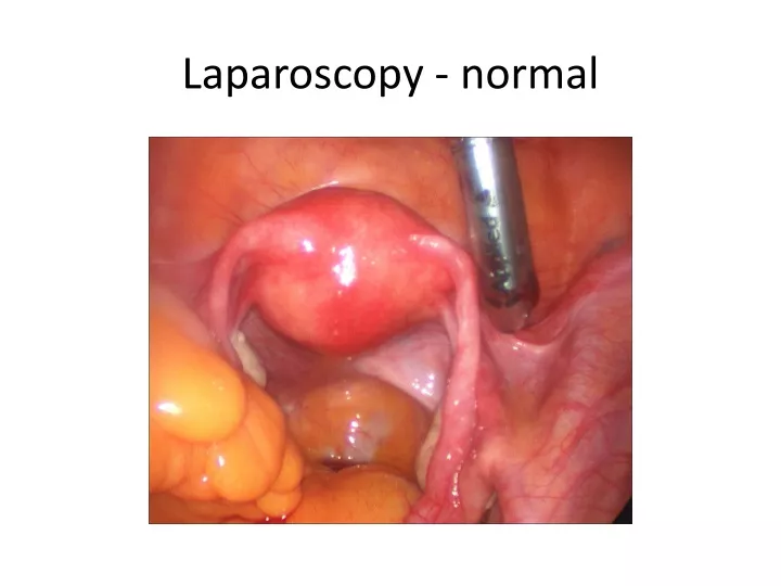laparoscopy normal