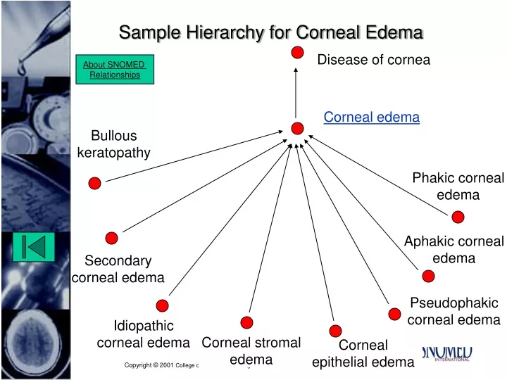sample hierarchy for corneal edema
