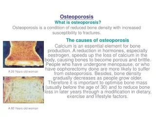 The causes of osteoporosis