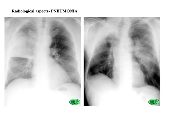radiological aspects pneumonia