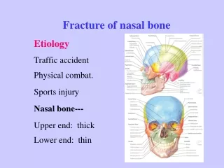 Fracture of nasal bone Etiology Traffic accident Physical combat. Sports injury Nasal bone---