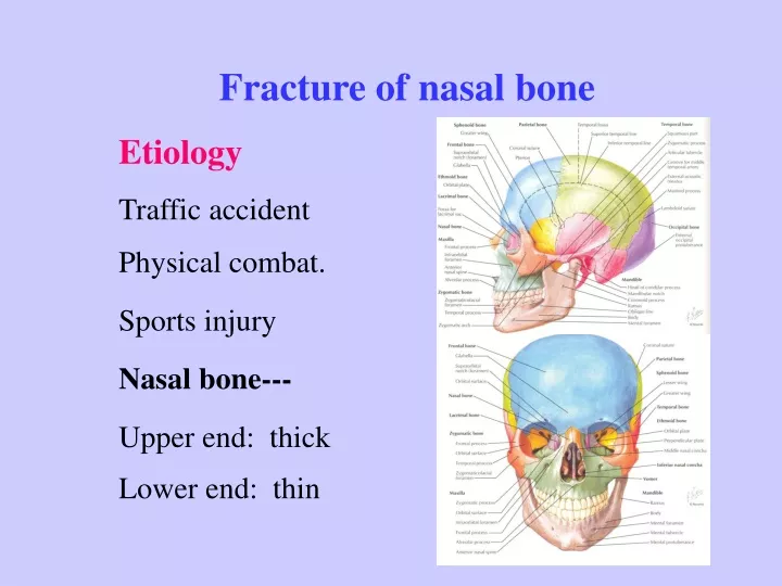fracture of nasal bone etiology traffic accident