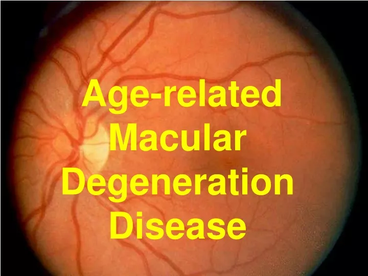 age related macular degeneration disease