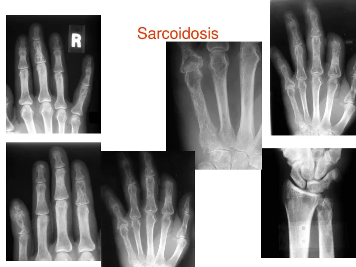 sarcoidosis