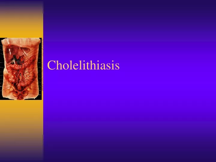 cholelithiasis