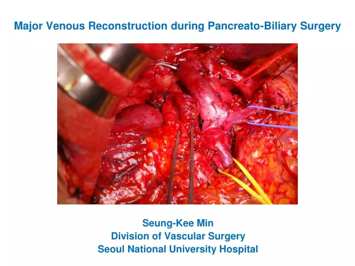 major venous reconstruction during pancreato biliary surgery