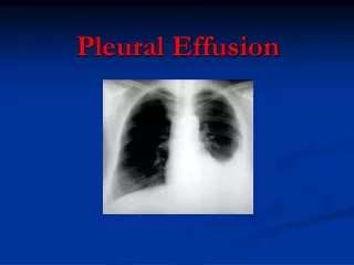 Pleural Effusion