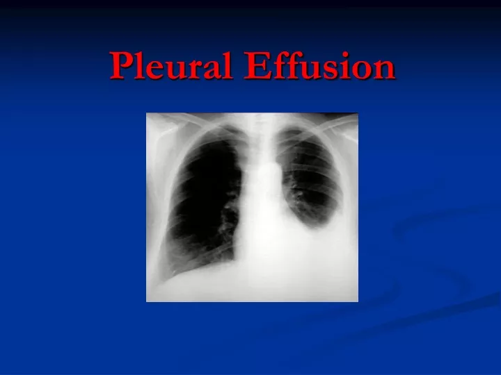 pleural effusion