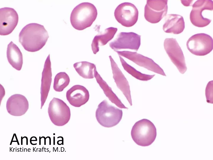 anemia