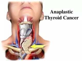 Anaplastic Thyroid Cancer