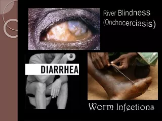 River Blindness (Onchocerciasis)