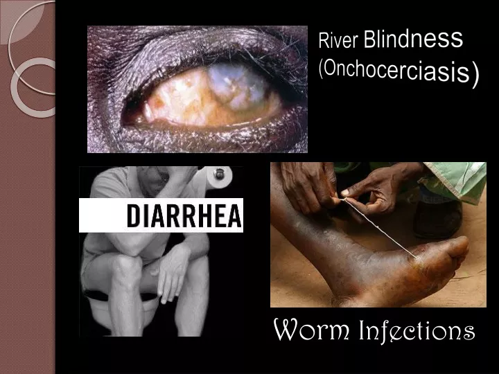 river blindness onchocerciasis