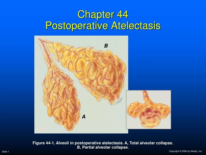 chapter 44 postoperative atelectasis