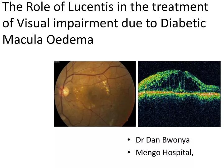 the role of lucentis in the treatment of visual impairment due to diabetic macula oedema