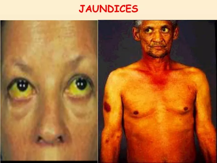 jaundices