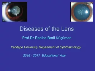 Diseases of the Lens