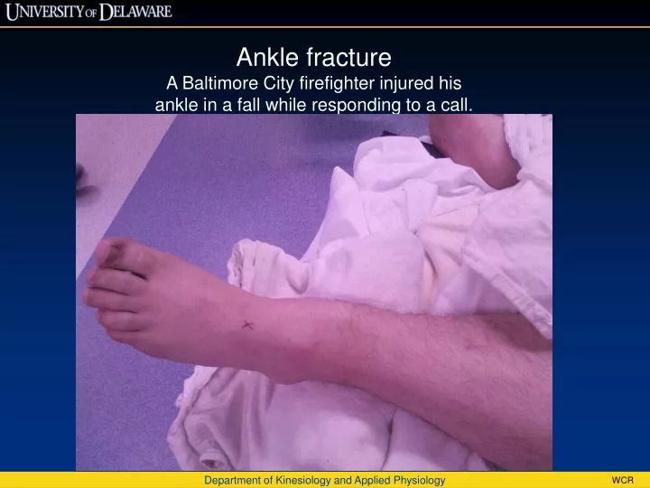 ankle fracture a baltimore city firefighter
