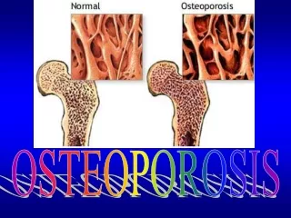 OSTEOPOROSIS