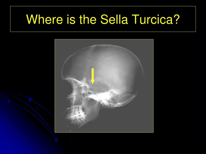 where is the sella turcica