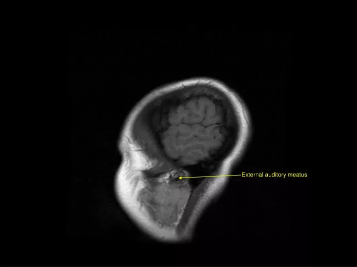 external auditory meatus