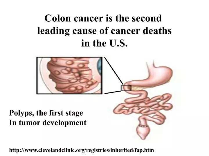 colon cancer is the second leading cause