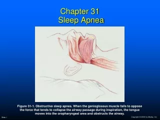 Chapter 31  Sleep Apnea