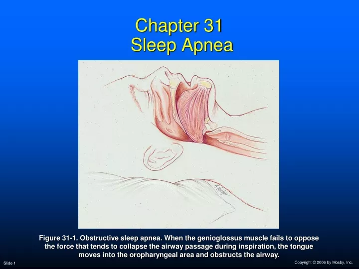 chapter 31 sleep apnea