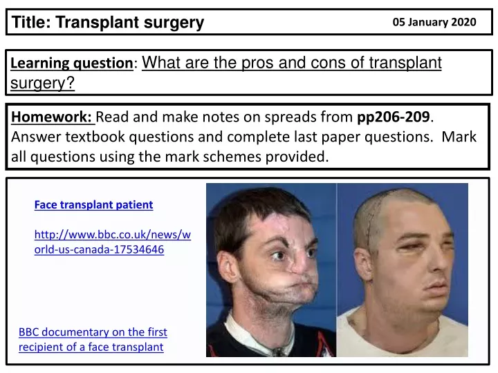 title transplant surgery