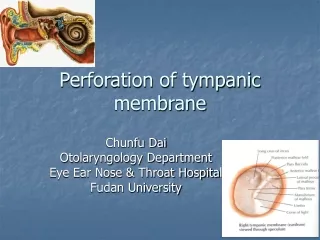 Perforation of tympanic membrane