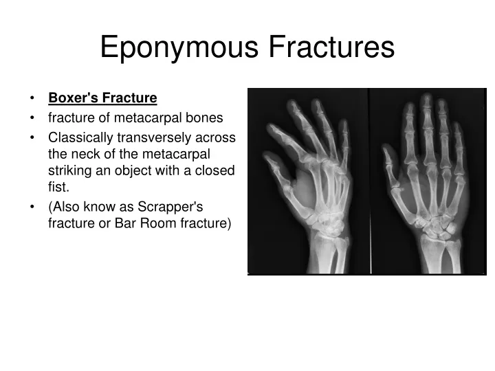 eponymous fractures