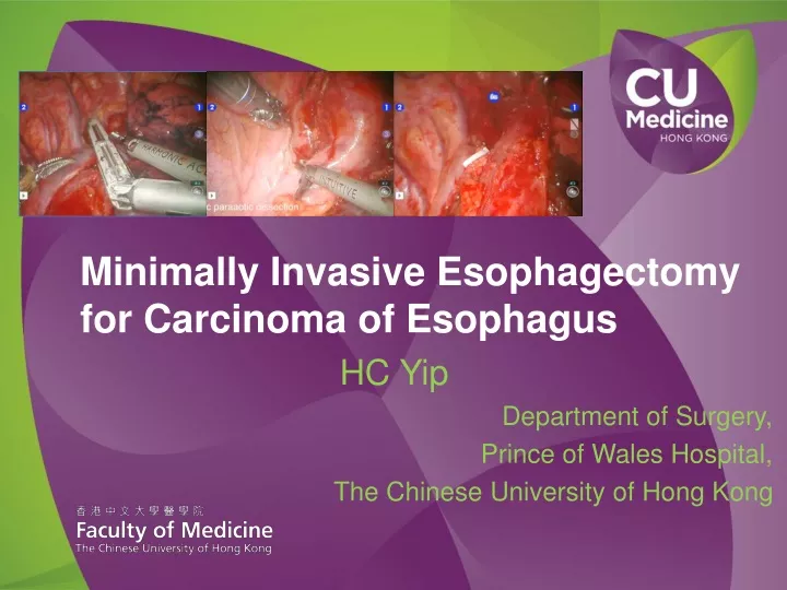 minimally invasive esophagectomy for carcinoma of esophagus