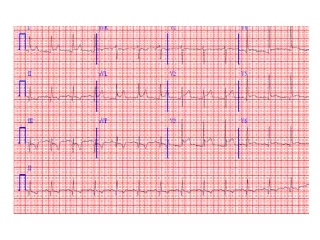 What types of pathology can we identify and study from EKGs?